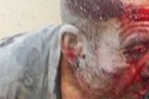 Подвергся избиению ополченец Смбат Акопян